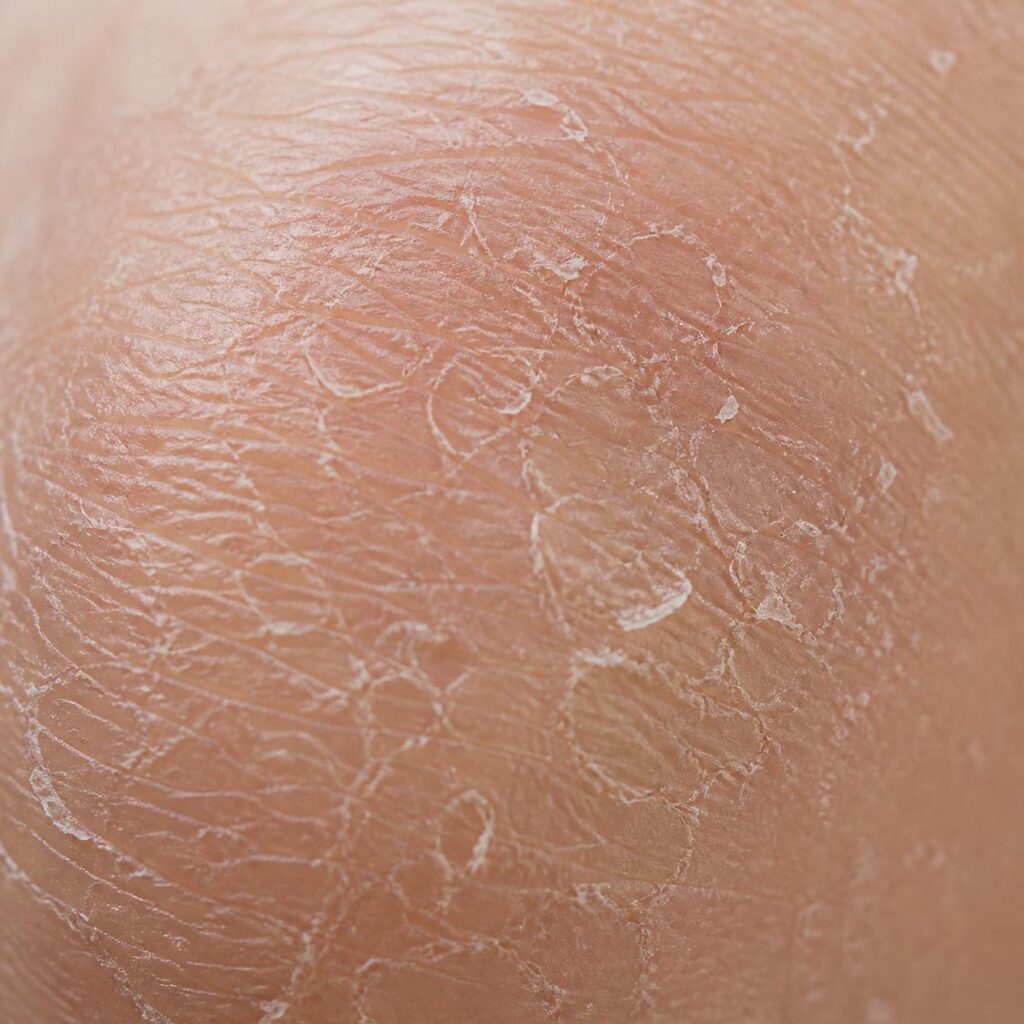 dry skin remedies
